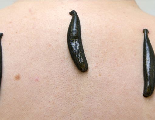 Terapi Lintah untuk Kesehatan, Efektifkah?