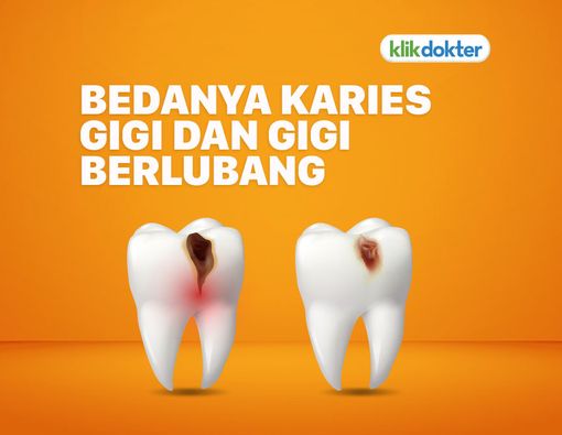 Karies Gigi dan Gigi Berlubang, Apa Bedanya?