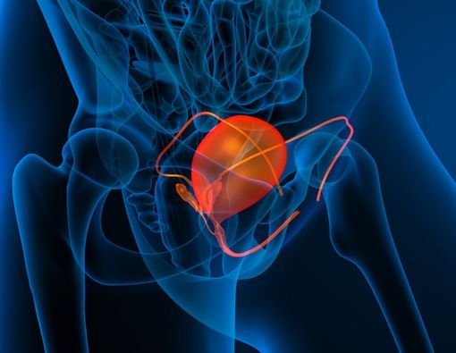 Mengenal Stadium Kanker Kandung Kemih dan Pengobatannya