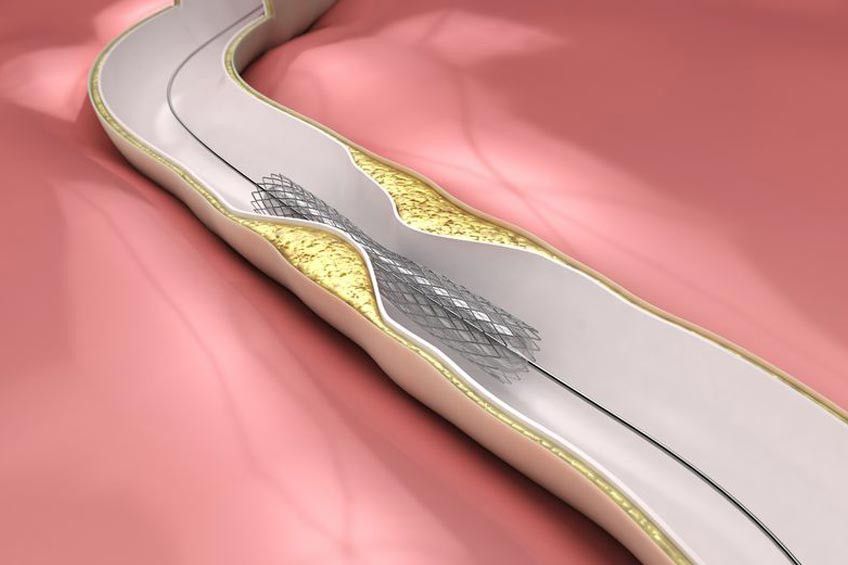 Kapan Ring Jantung Diperlukan?