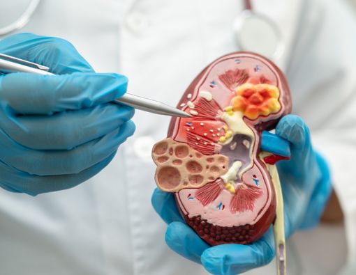 Kenali Risiko Hidup dengan Satu Ginjal!