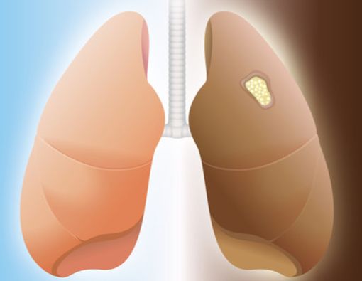 Benarkah Buruh Pabrik Rentan Kena Penyakit Paru?