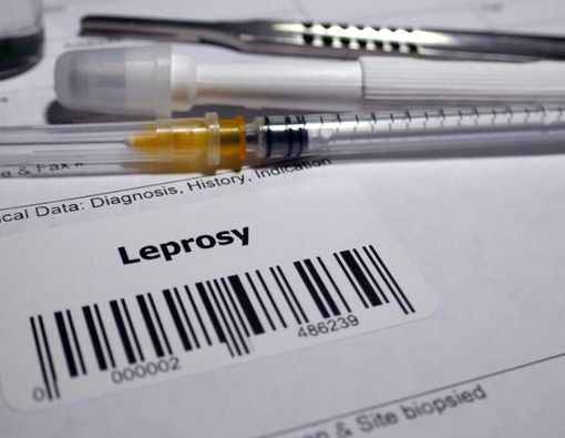 Cara Mengobati Penyakit Kusta secara Medis  