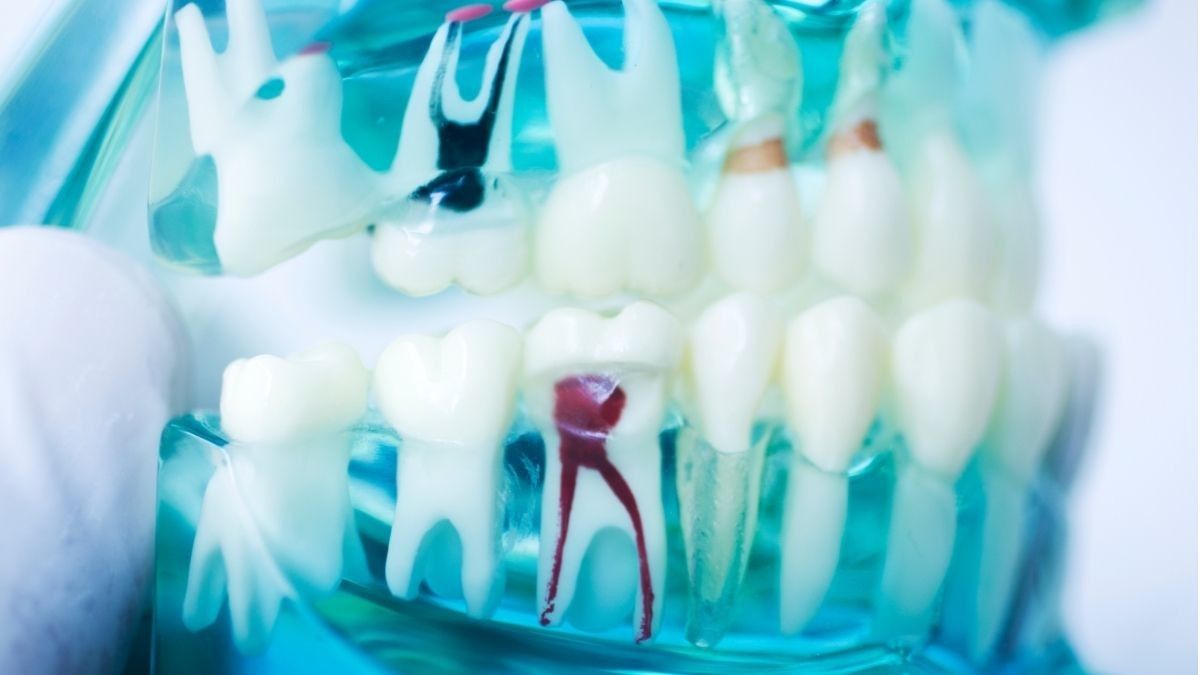 Tahapan Kerusakan Gigi dan Perawatan yang Bisa Dilakukan