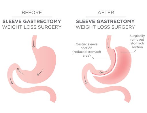 Amankah Pengecilan Lambung untuk Turunkan Berat Badan?