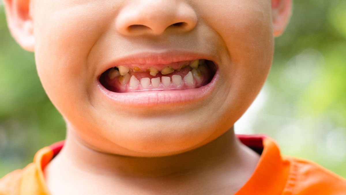 Kebiasaan Buruk Yang Bisa Merusak Gigi Anak