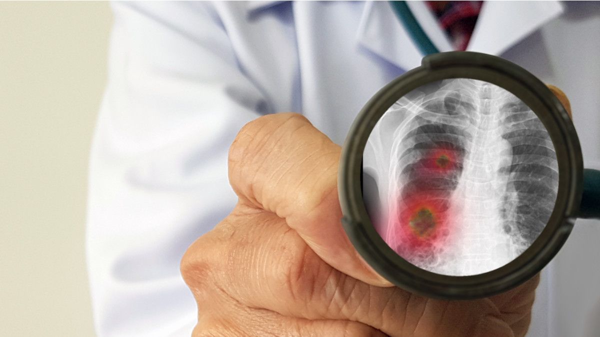 Mayoritas Pasien Positif Virus Corona Mengalami Pneumatosis, Apa Itu?