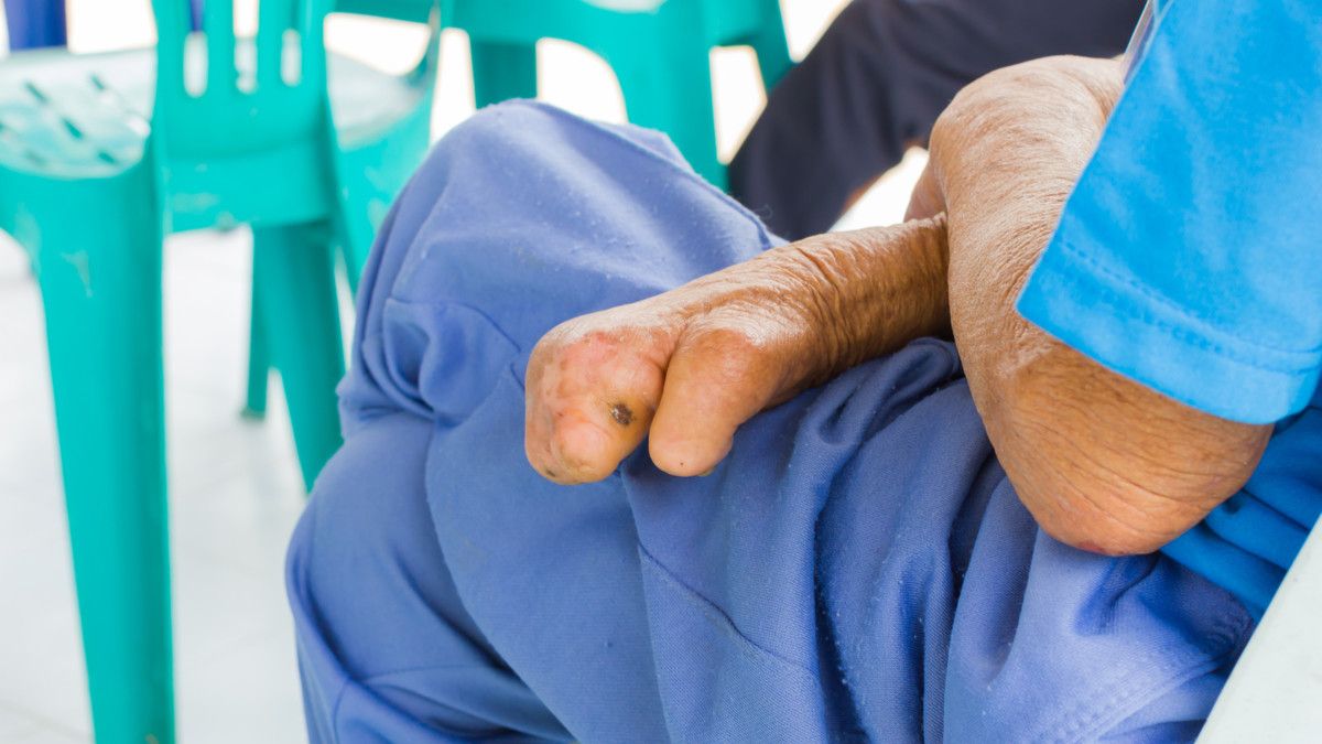 Komplikasi yang Sering Dialami Penderita Penyakit Kusta