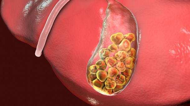 Kolesterol Tinggi Bisa Sebabkan Batu Empedu?