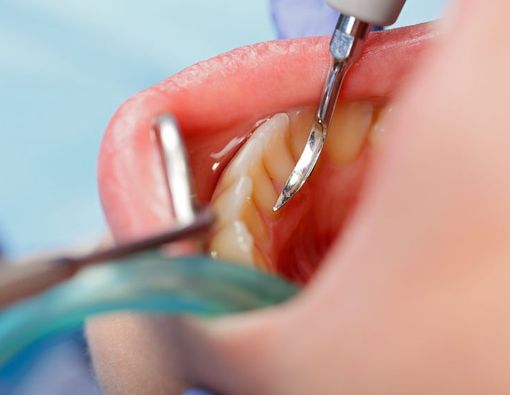 Cara Membersihkan Karang Gigi di Rumah