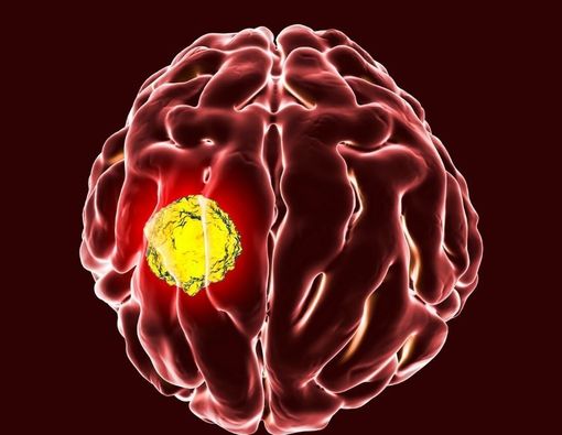 Faktor Risiko Kanker Otak yang Perlu Anda Waspadai
