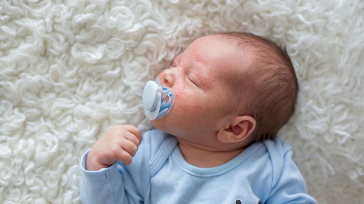 Penyebab dan Pengobatan Dermatitis Atopik pada Anak (Tatyana Tomsickova/123rf)