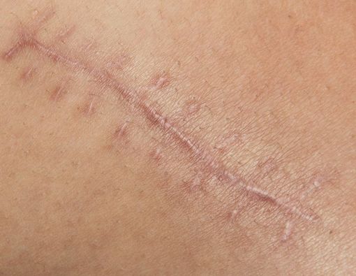 Cara Menghilangkan Bekas Luka: Obat, Prosedur Medis, dan Herbal