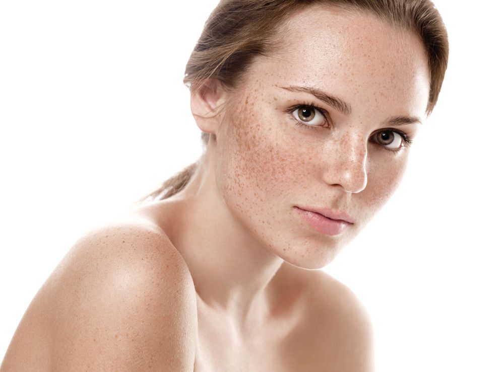 Freckles, Berbahayakah bagi Kesehatan?