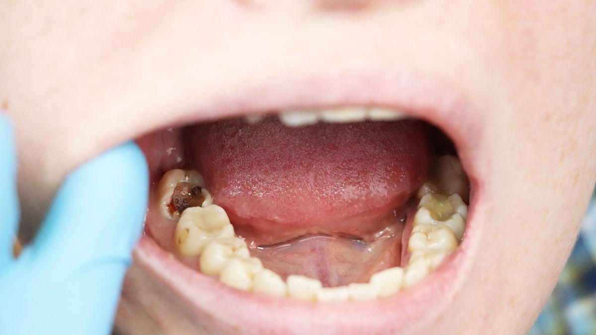 Penyebab Crown Gigi Permanen Sakit