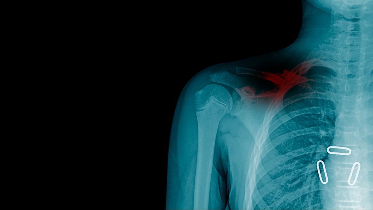 Penyakit Tulang Selangka yang Mungkin Terjadi