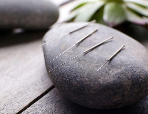 Mengatasi Sakit Kepala dengan Akupunktur