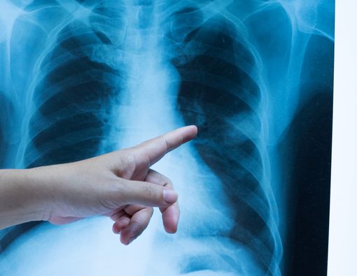 Penyebab Tuberkulosis Kelenjar, Penyakit yang Sering Sembunyi