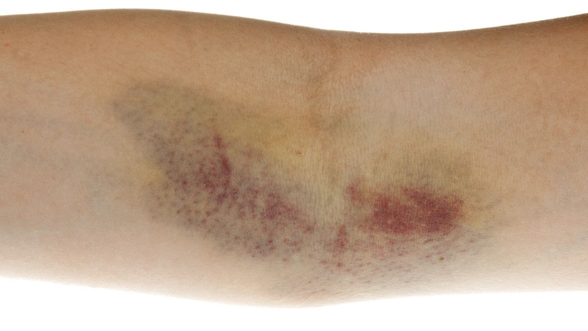 Arti Warna Memar pada Tubuh Anda