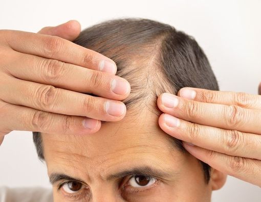 Rambut Pria Bisa Rontok Akibat Masturbasi atau Onani, Benarkah?