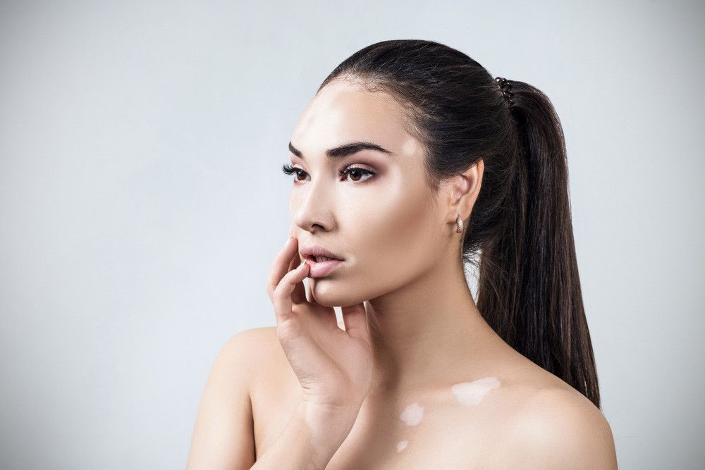 Penyebab Bercak Putih di Wajah