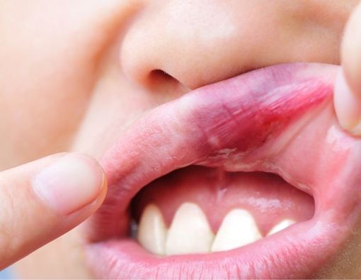 Perawatan untuk Robek Mulut Bagian Dalam
