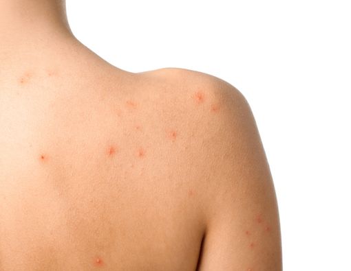 11 Hal Tak Terduga Penyebab Jerawat di Punggung