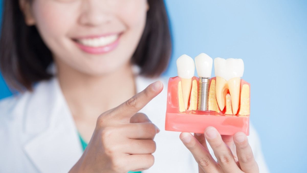 Cara Merawat Implan Gigi agar Tetap Sehat dan Kuat