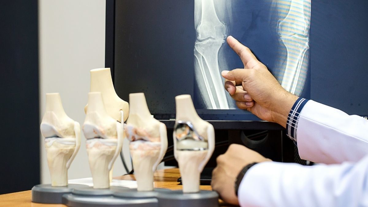 8 Kebiasaan Penyebab Osteoporosis, Bikin Tulang Keropos!