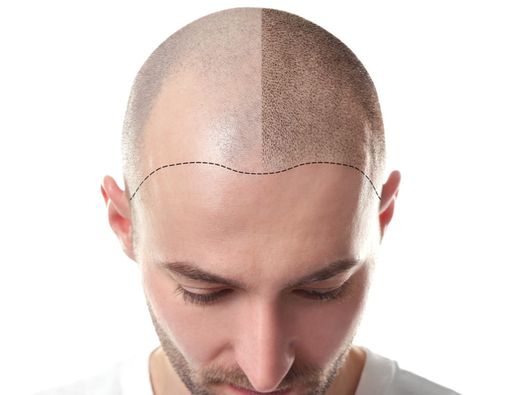 Sebelum Transplantasi Rambut, Ketahui Ini Dulu