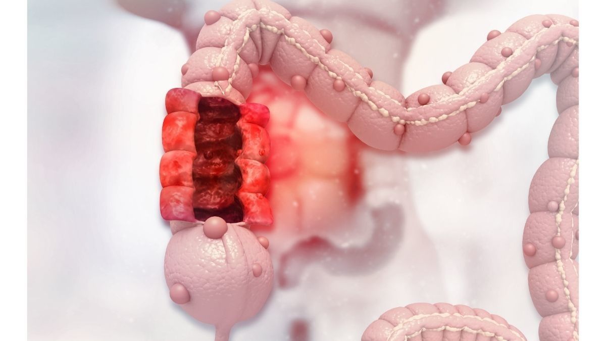 Hal yang Tidak Boleh Dilakukan Setelah Sembuh dari Kanker Kolon