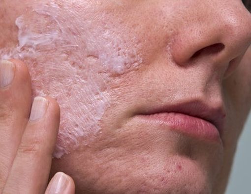 4 Cara Mudah Untuk Mencegah Bekas Jerawat