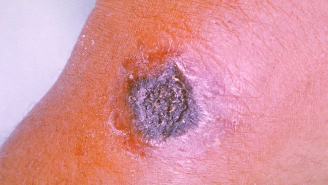 Kenali Ciri-ciri Kulit Kena Antraks