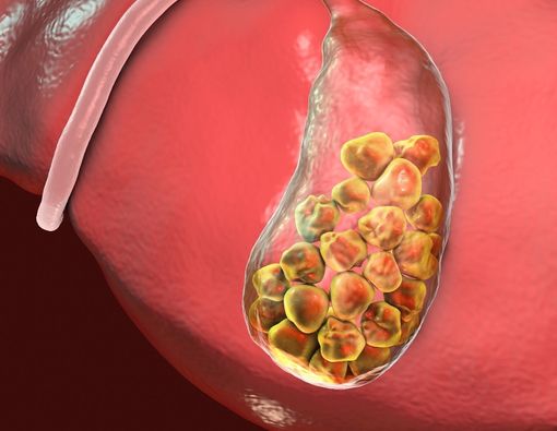 Kolesterol Tinggi Bisa Sebabkan Batu Empedu?