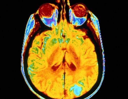 Catat, Ini Komplikasi Kanker Otak yang Perlu Diwaspadai