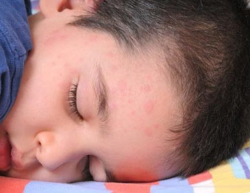 Biduran Sama dengan Alergi Dingin?