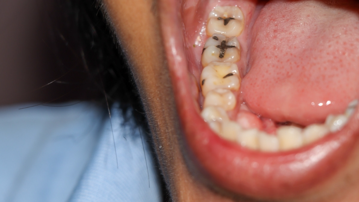 Punya Gigi Berlubang, Bolehkah Melakukan Veneer?