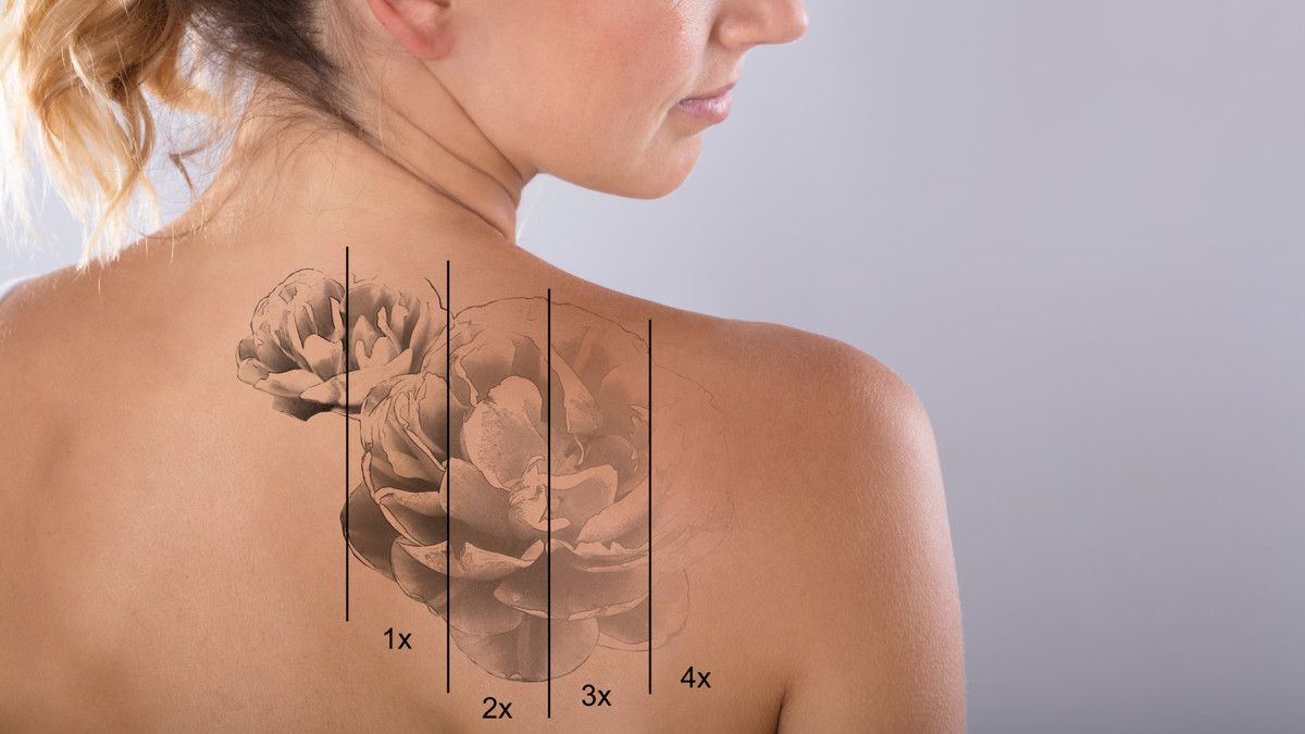 5 Pilihan Cara untuk Menghapus Tato Permanen