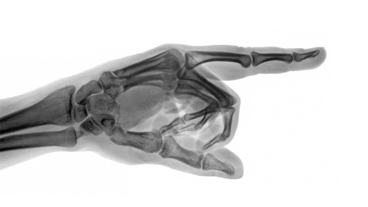 Mengenal Jenis-Jenis Kanker Tulang