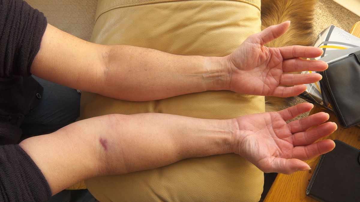 Tanda Limfadema yang Perlu Kamu Waspadai