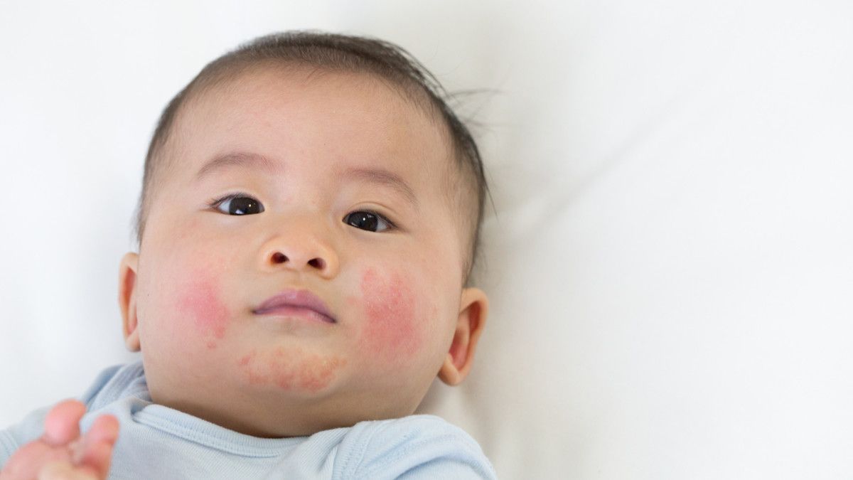 Ada Jerawat pada Bayi, Ini Penyebab dan Cara Mengatasinya