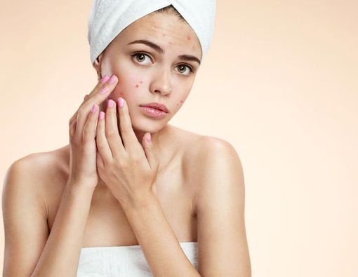 Benarkah Darah Haid Bisa Hilangkan Jerawat?