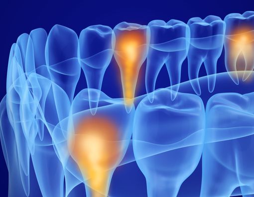 Mengenal Pulpotomi, Metode Bedah untuk Atasi Polip Pulpa di Gigi