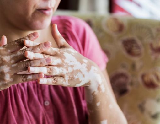10 Cara Menghilangkan Vitiligo pada Kulit, dari Terapi Cahaya Hingga Cangkok