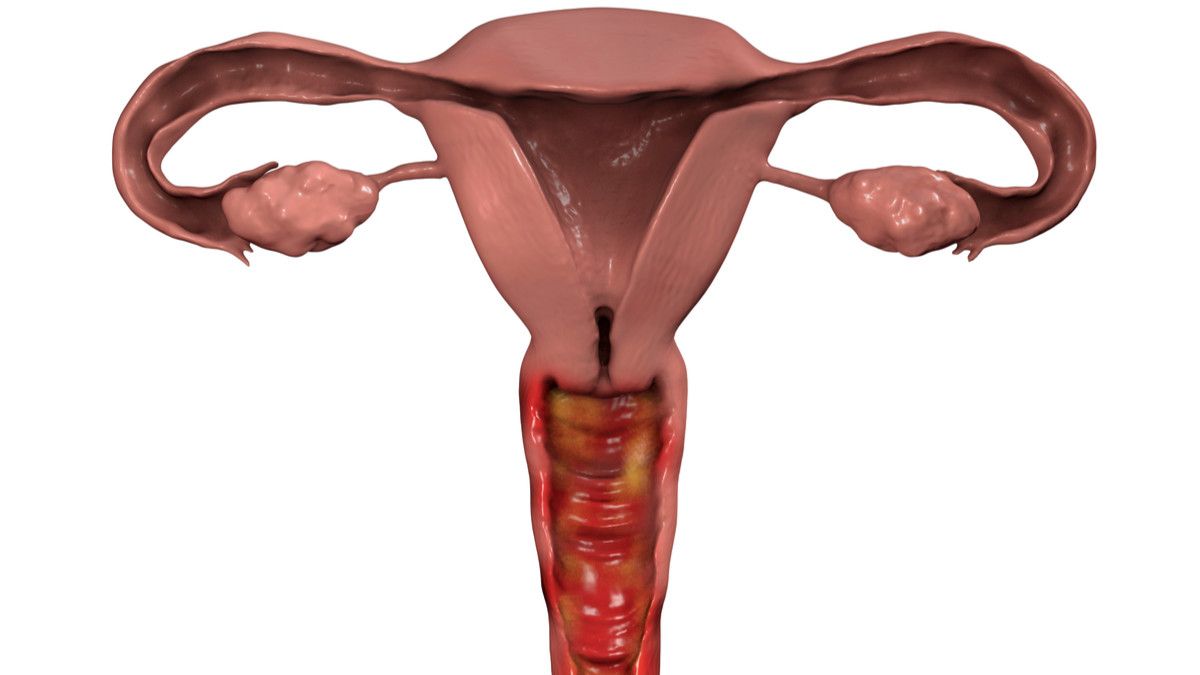 Kena Servisitis Saat Hamil, Bahaya atau Tidak?