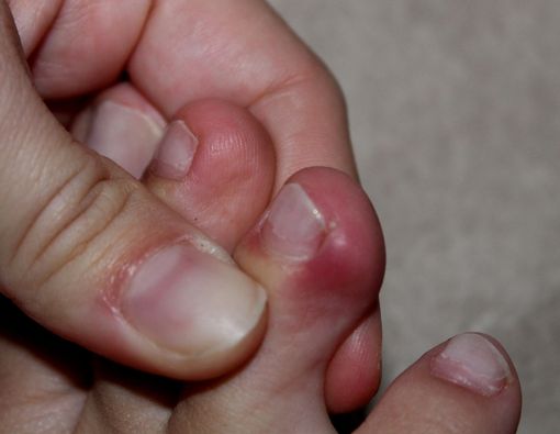 Prosedur Atasi Jempol Kaki Cantengan di Rumah