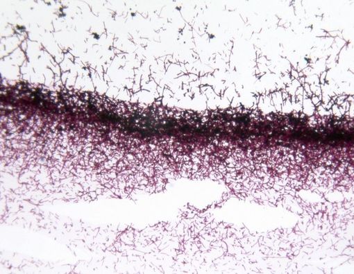 Beragam Tips Diet untuk Melawan Infeksi Jamur Candida