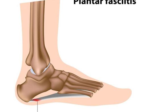 Radang Sendi pada Tumit Kaki