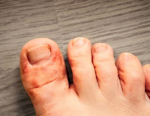 7 Obat Kutu Air Alami untuk Pengobatan di Rumah