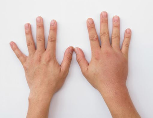 Penyebab Jari Bengkak yang Jarang Diketahui